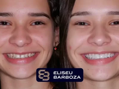 A paciente tinha dentes pequenos e afastados, mas não queria usar aparelho. Propomos e resolvemos com facetas em resina esculpidas a mão.