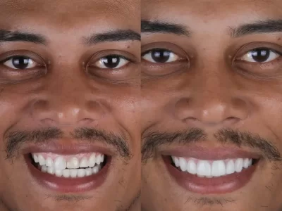 Paciente satisfeito com nossas facetas de resina esculpidas a mão. Planejadas em computador.