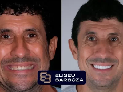 ANTES-E-DEPOIS-charles