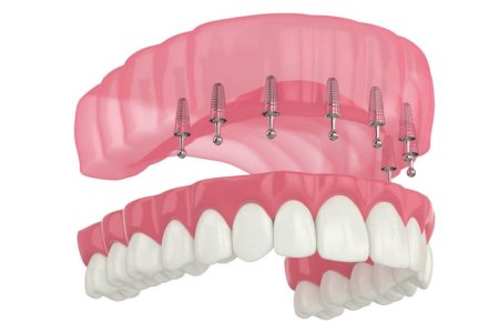 eliseu-dentista-implante