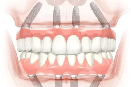 eliseu-dentista-implante