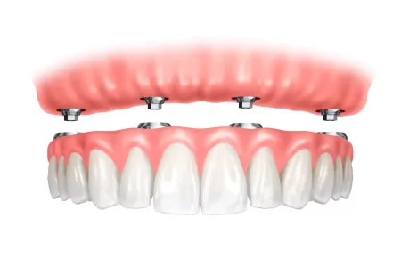 protocolo-sobre-implante-eliseu-barboza-odontologia